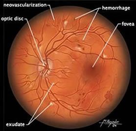 retina diabetes